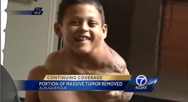 1/3rd of boy's massive tumor removed | 12newsnow.com